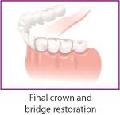 Dental Bridge – Traditional Dental Bridges, Cantilever Bridges