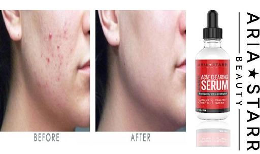 Anti Acne Skin Care Serum for Clear Skin