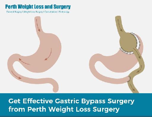 Get Effective Gastric Bypass Surgery from Perth Weight Loss Surgery