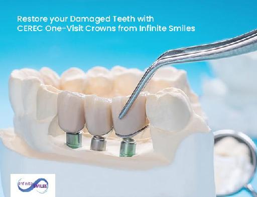 Restore your Damaged Teeth with CEREC One-Visit Crowns
