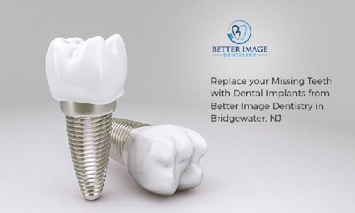 Replace your Missing Teeth with Dental Implants