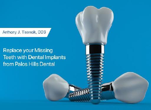 Replace your Missing Teeth with Dental Implants